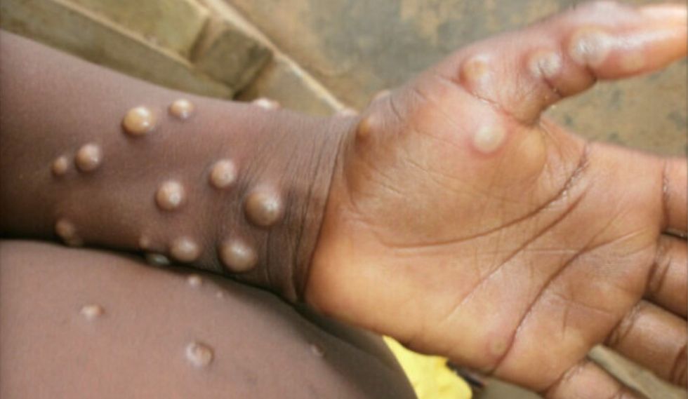 A case of monkeypox