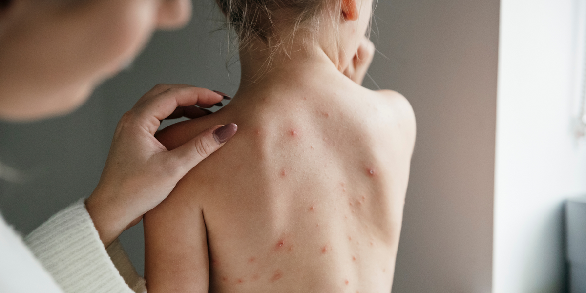 NextImg:Millions of British children to be vaccinated for chickenpox