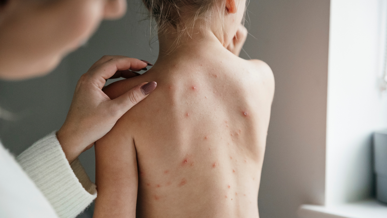 A child with chickenpox