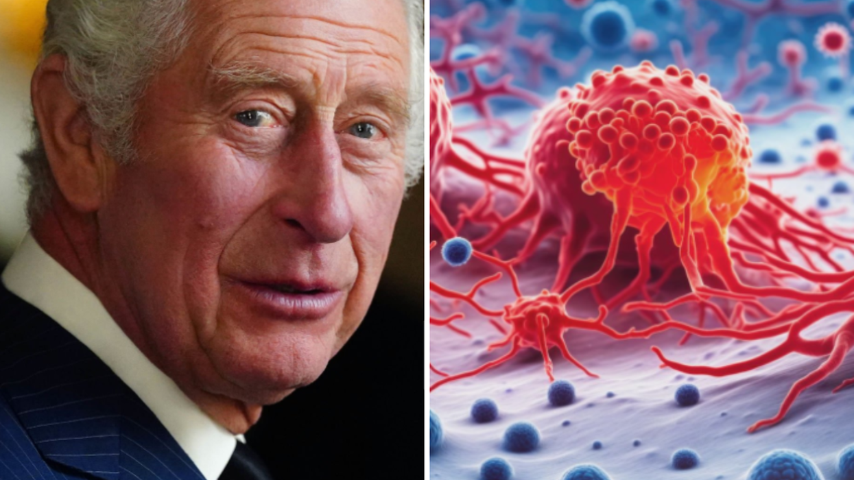 A composite image of King Charles on the left and a cancer cell on the right