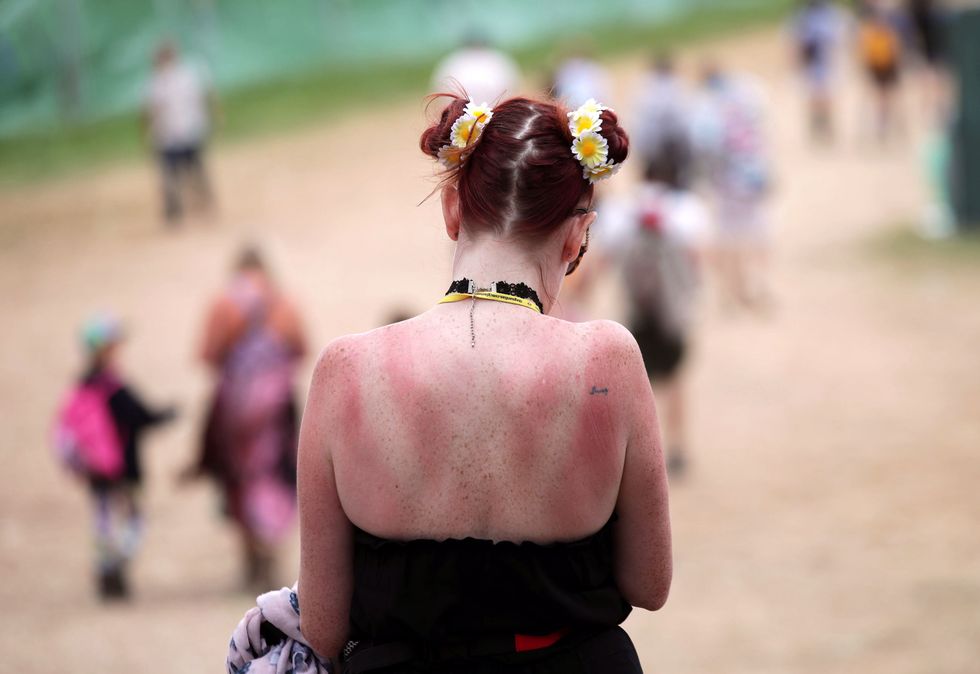 A festivalgoer with a sunburnt back at Glastonbury Festival, at Worthy Farm in Somerset