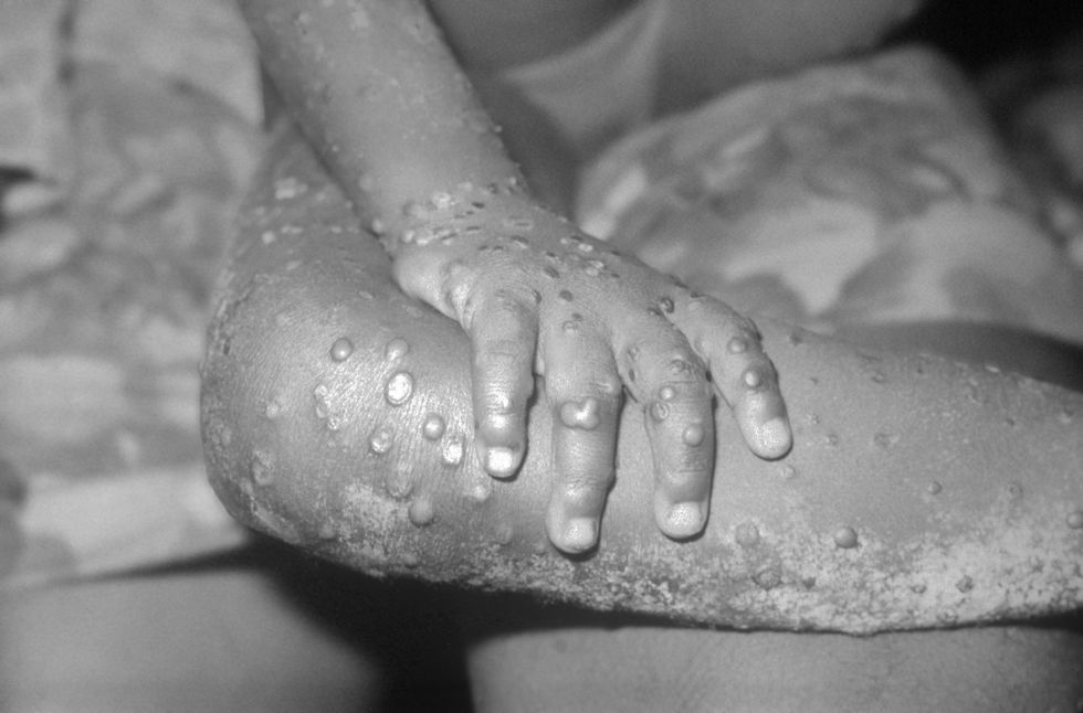 A further 11 cases of monkeypox have been confirmed in the UK