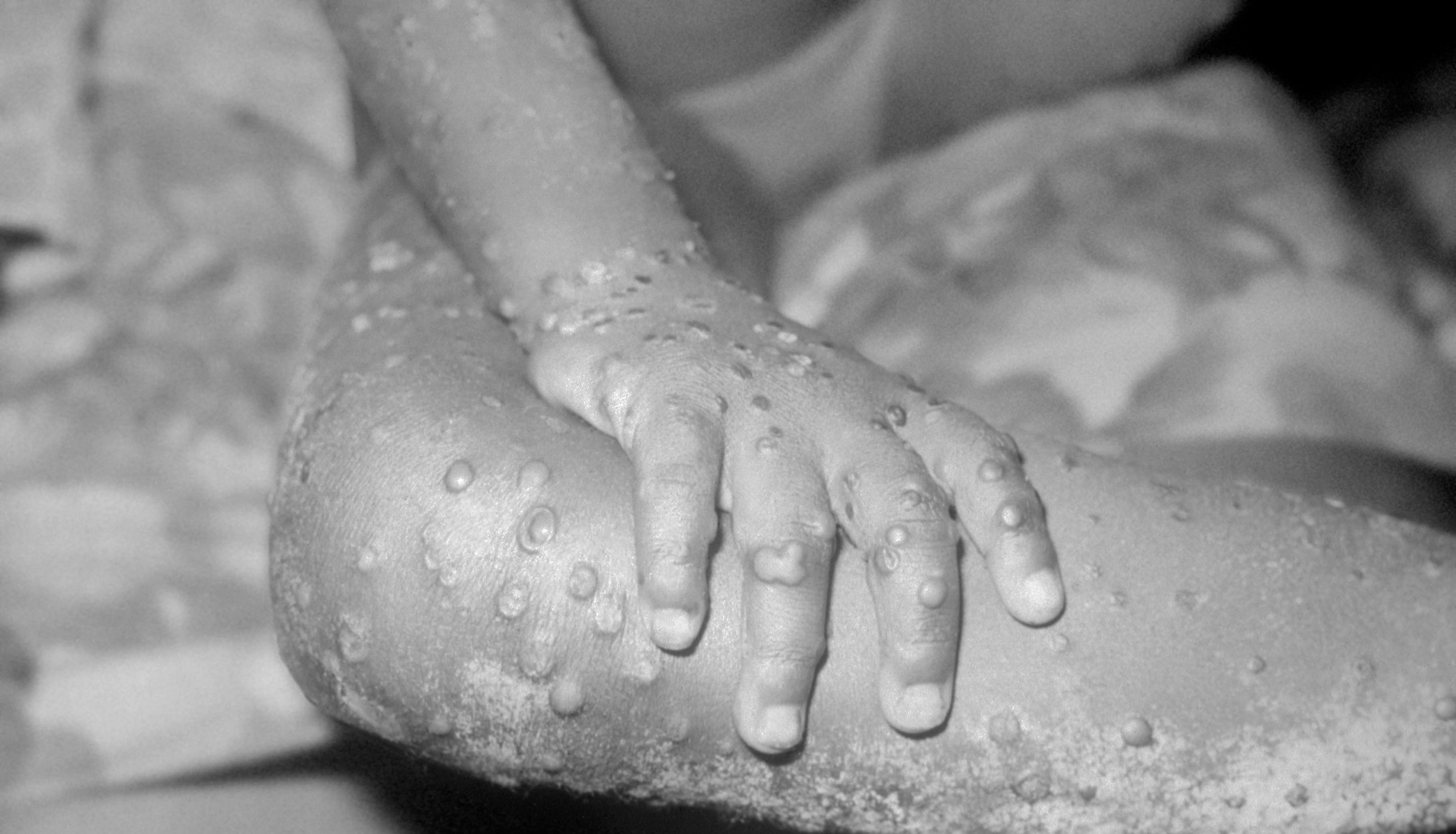 A generic photo of a monkeypox rash