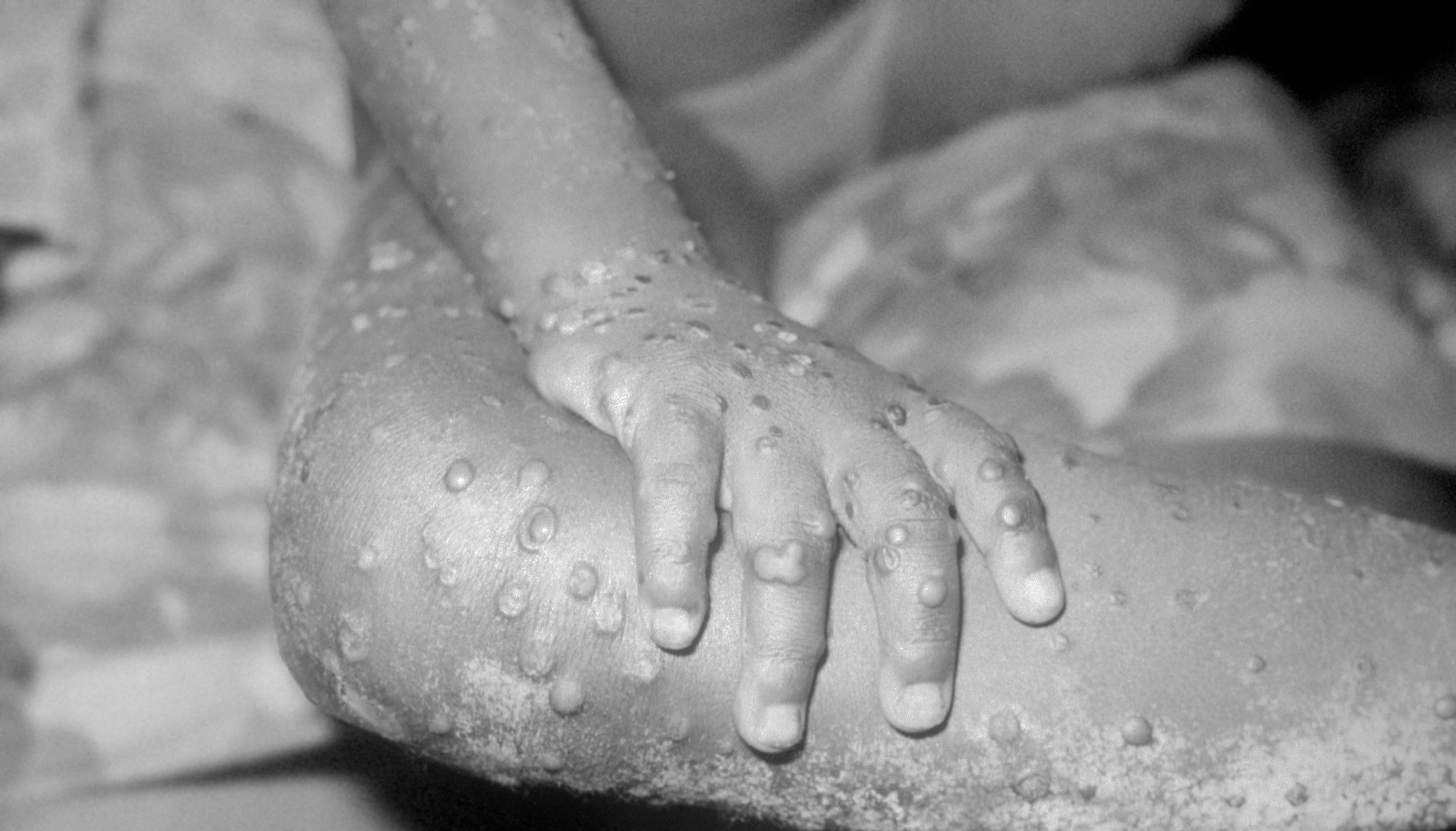 A Generic Photo of monkeypox rash