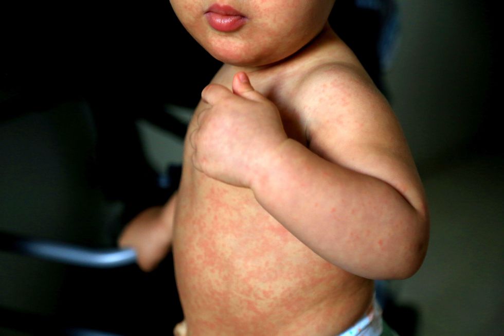 A generic stock photo of a child with a measles rash. See PA Feature FAMILY Measles. Picture credit should read: Alamy/PA. WARNING: This picture must only be used to accompany PA Feature FAMILY Measles.
