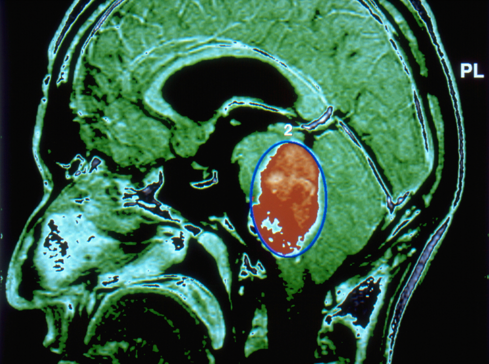 A head MRI showing a large tumor in orange