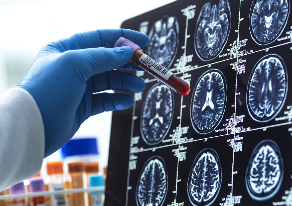 Neurologists determine widespread blood check to foretell likelihood of creating extreme Alzheimer’s