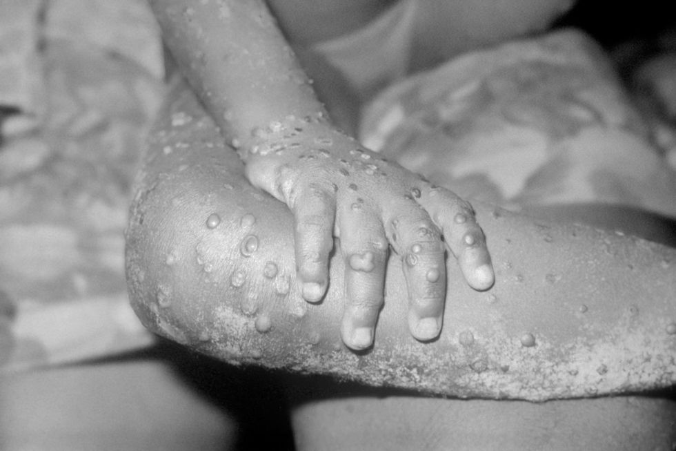 A monkeypox rash can be aggressive.