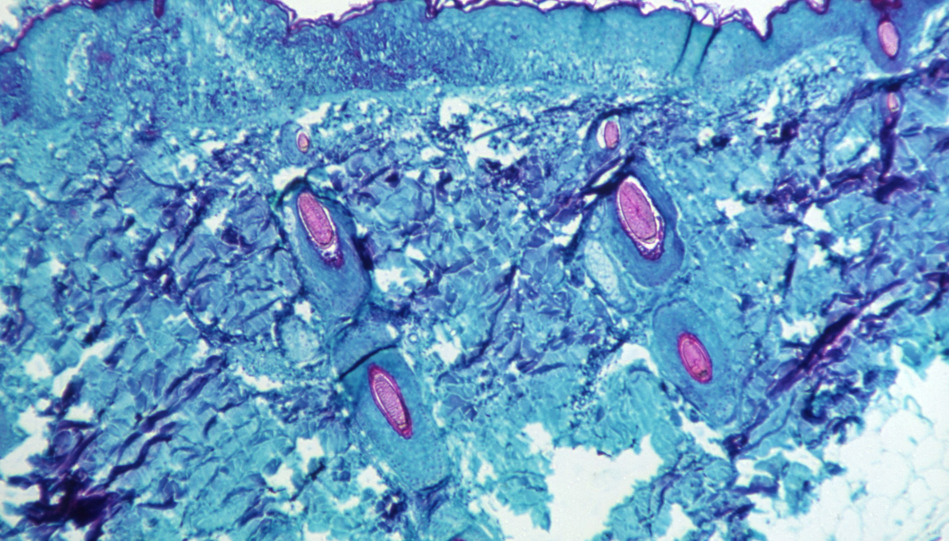 A section of skin tissue, harvested from a lesion on the skin of a monkey, that had been infected with monkeypox