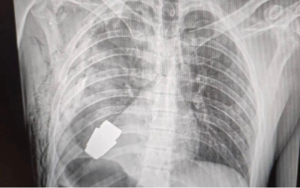 A Ukrainian soldier had to have an unexploded grenade surgically removed after it was lodged in his torso.