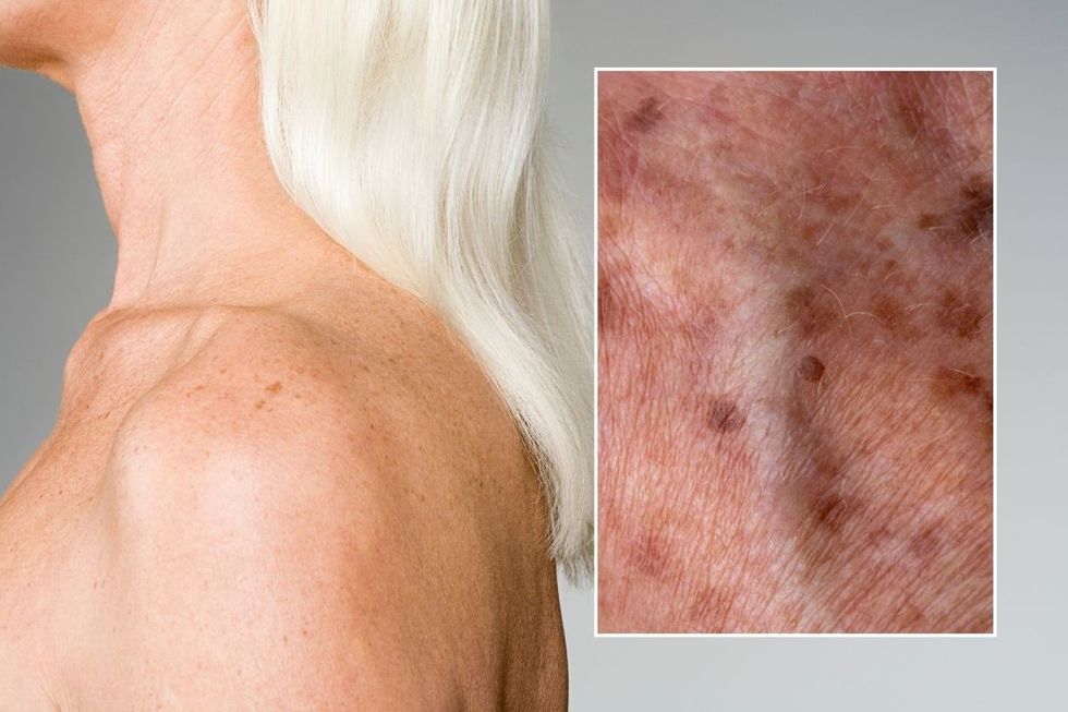 AGE SPOTS AND WOMAN STOCK