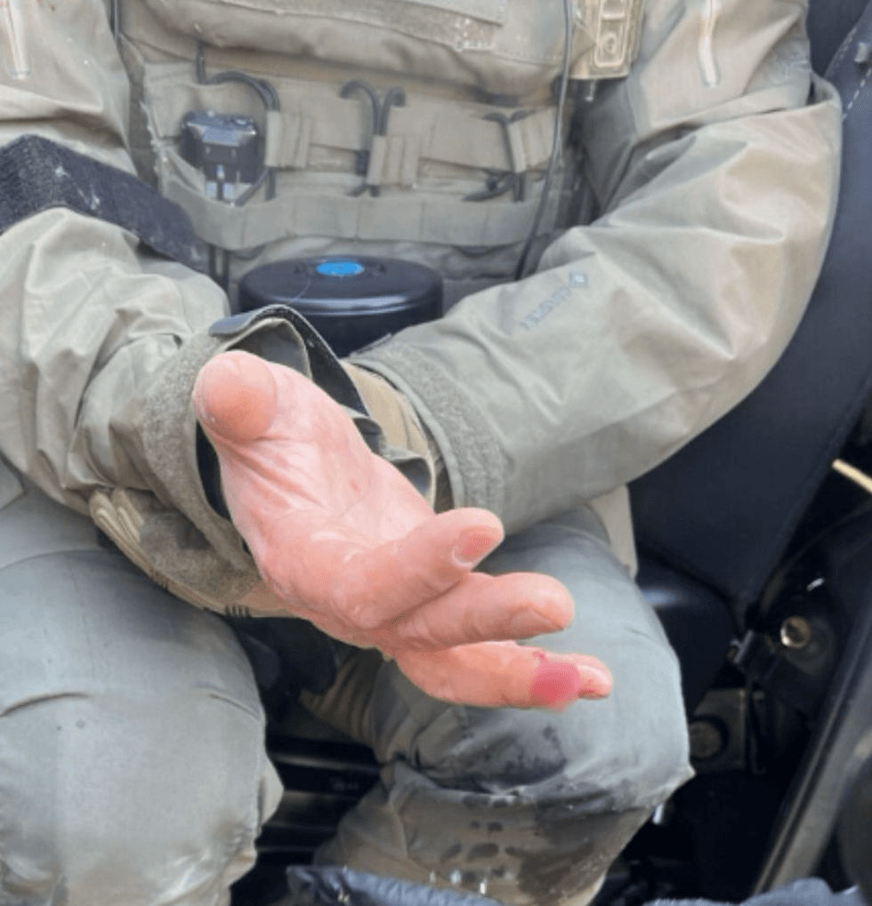 Agent finger bitten off Minneapolis