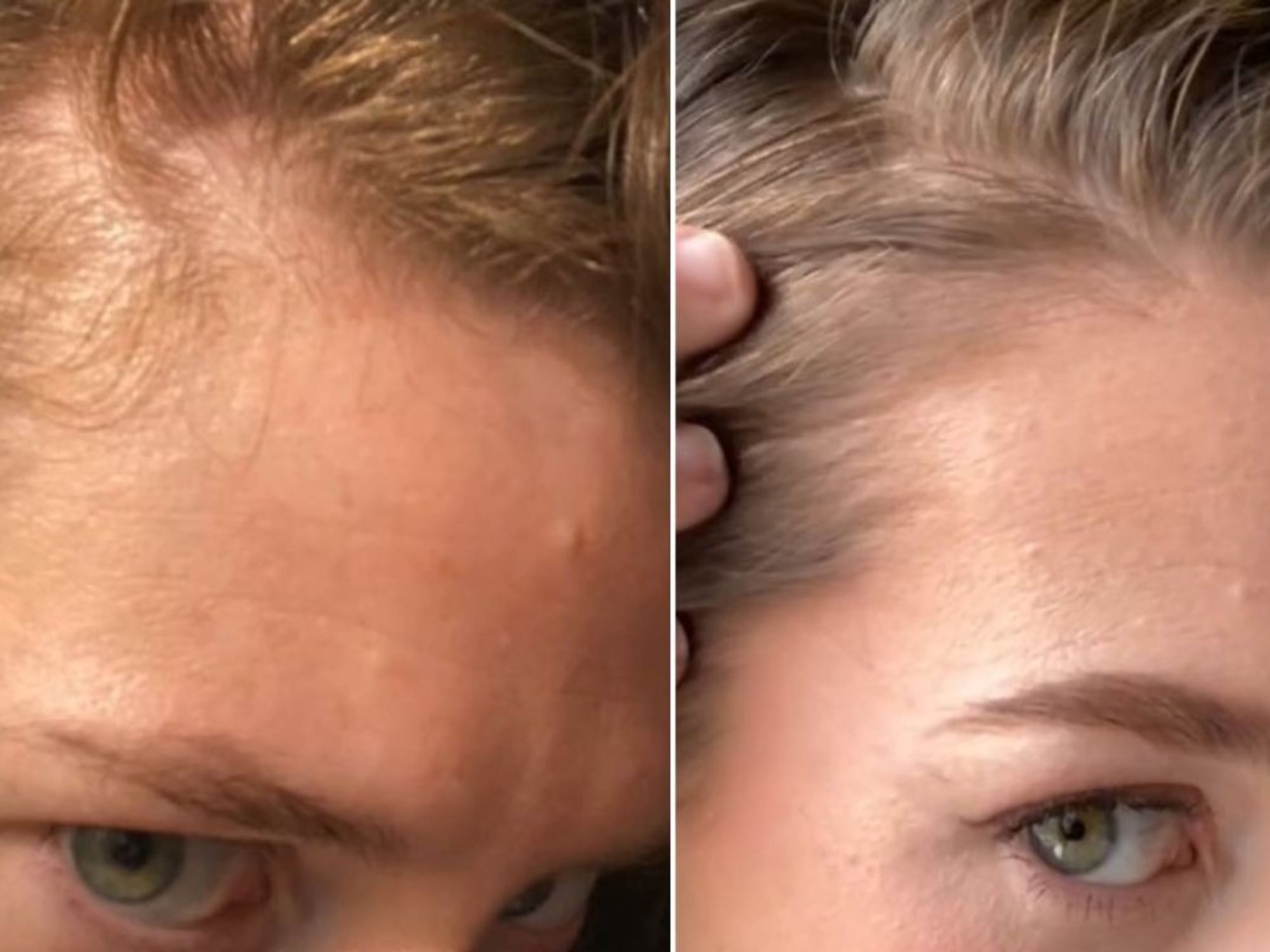 ally showing hair thinning around temples