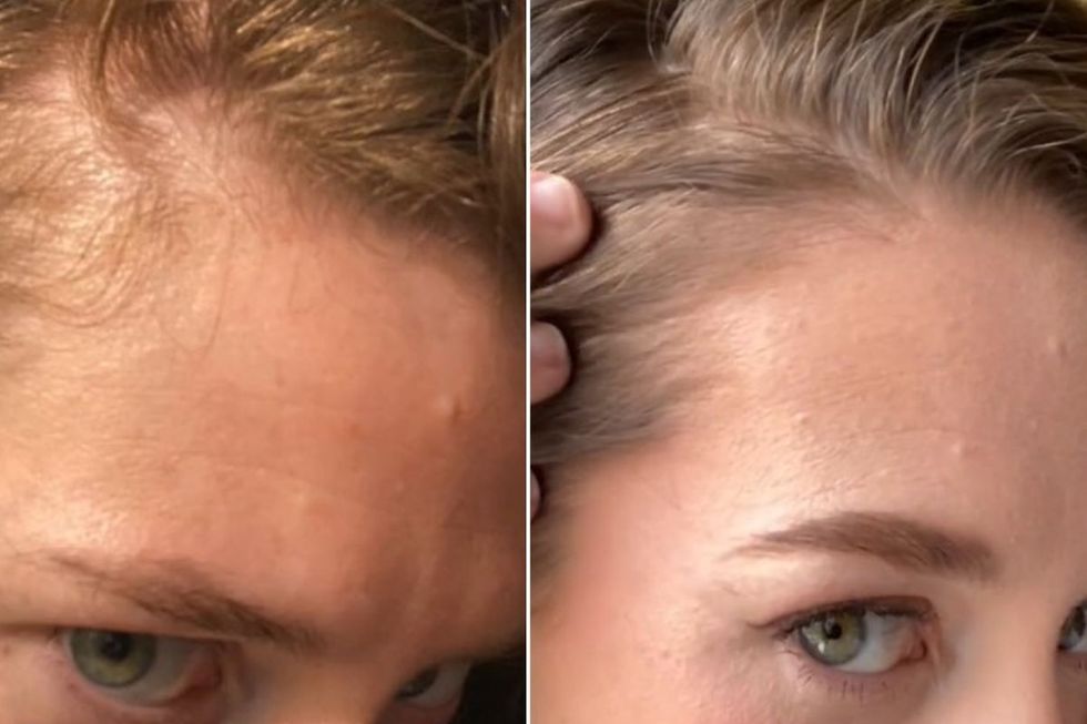 ally showing hair thinning around temples