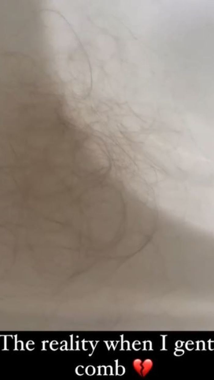 Amy Dowden hair loss