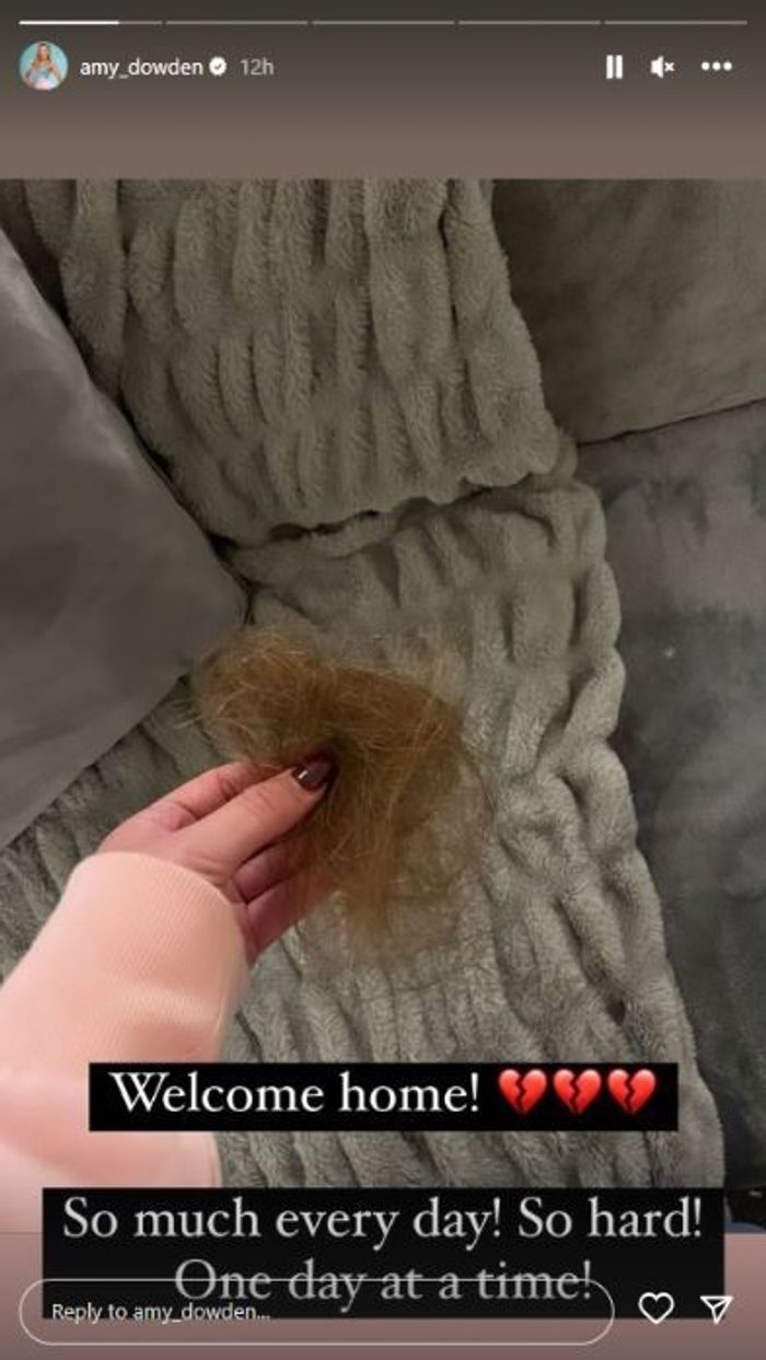 Amy Dowden hair loss