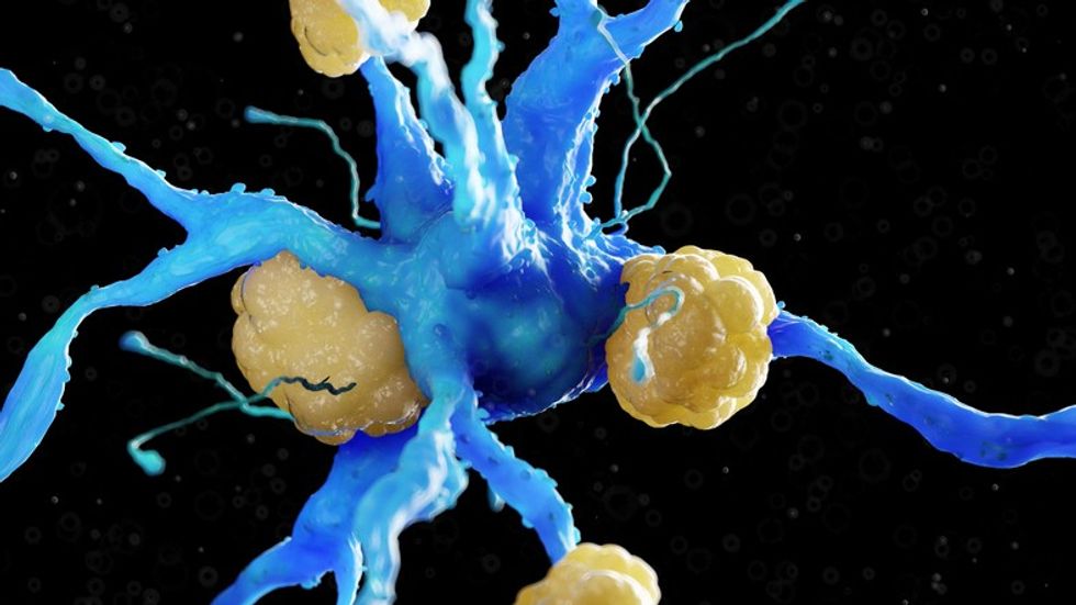 Amyloid plaques on nerve cell