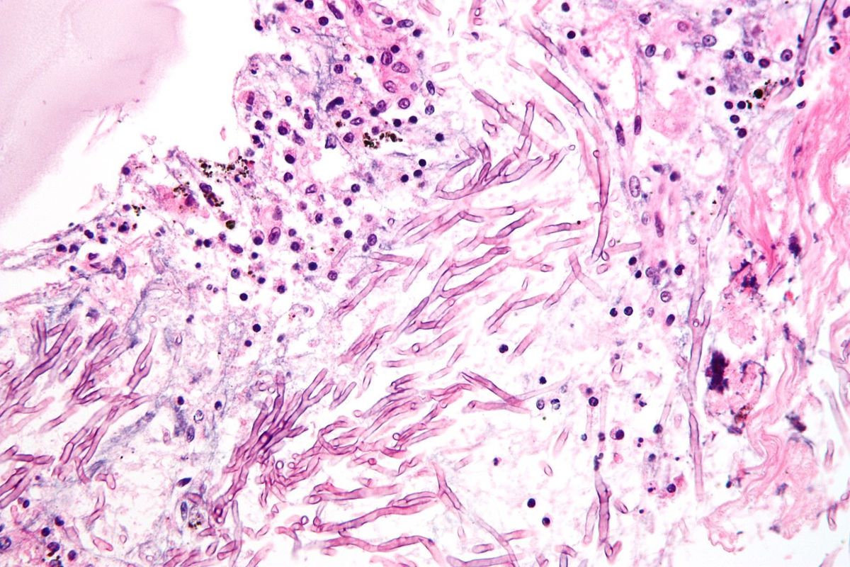 An image of a fungal disease