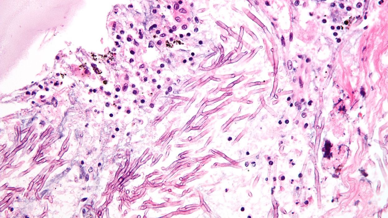 An image of a fungal disease