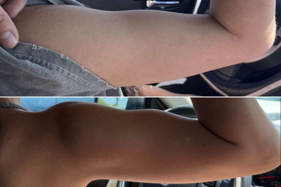 ARM transformation before and after