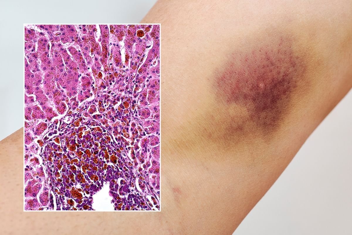 arm with bruise