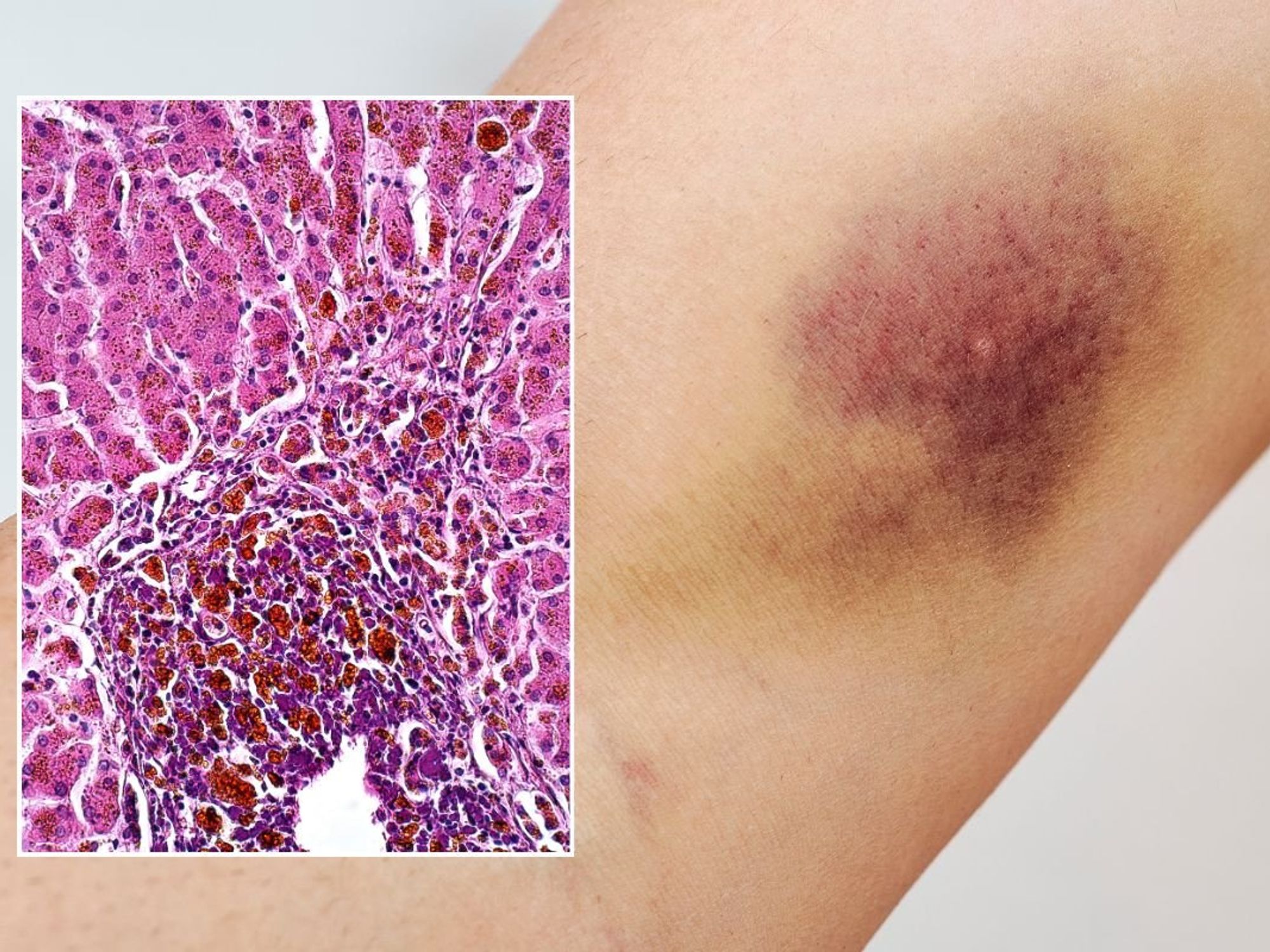 arm with bruise