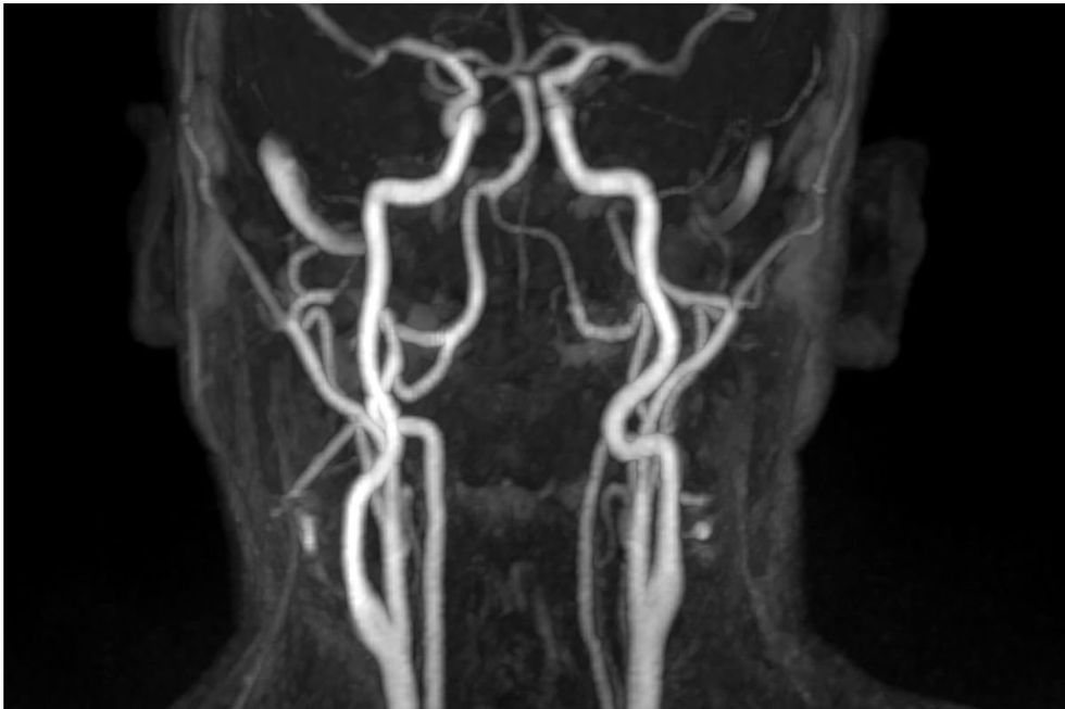 ARTÉRIAS QUE CONDUZEM O CÉREBRO