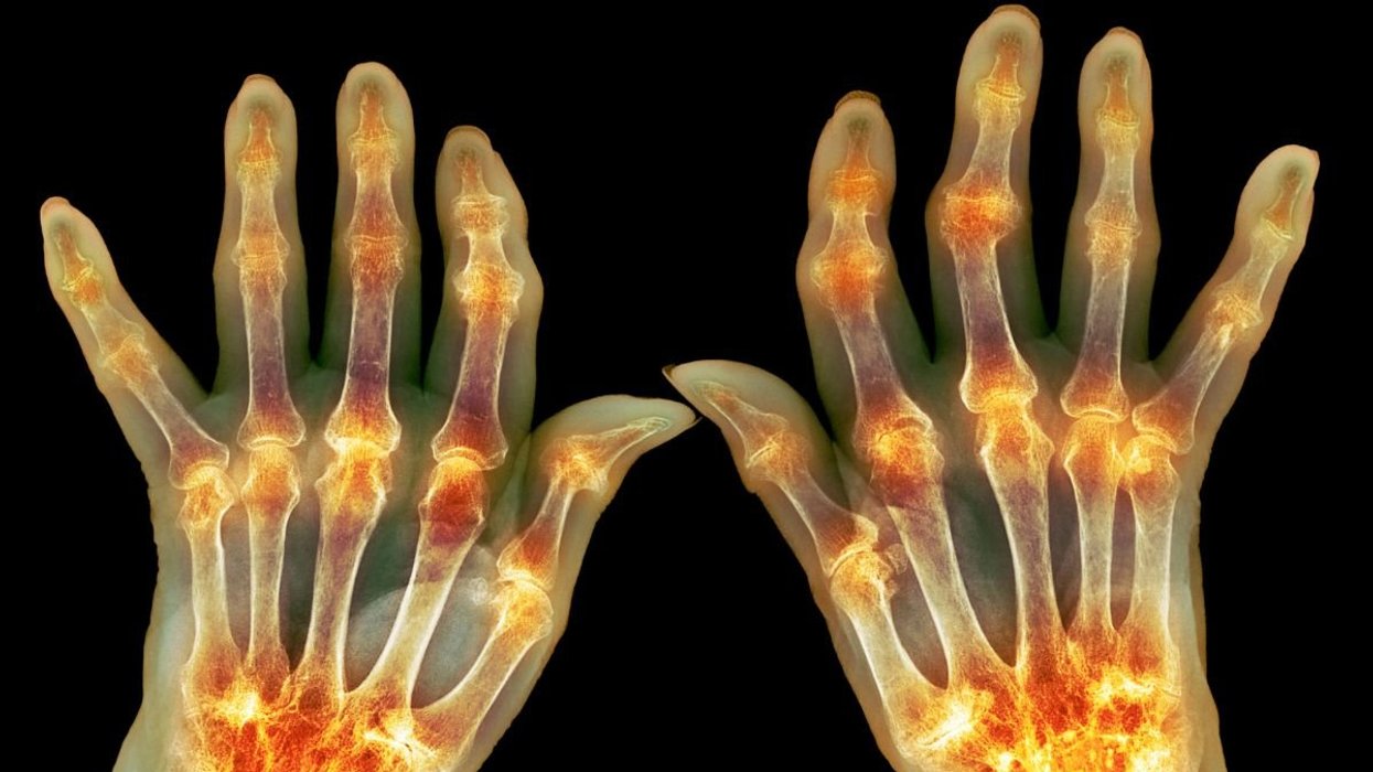 ARTHRITC HANDS