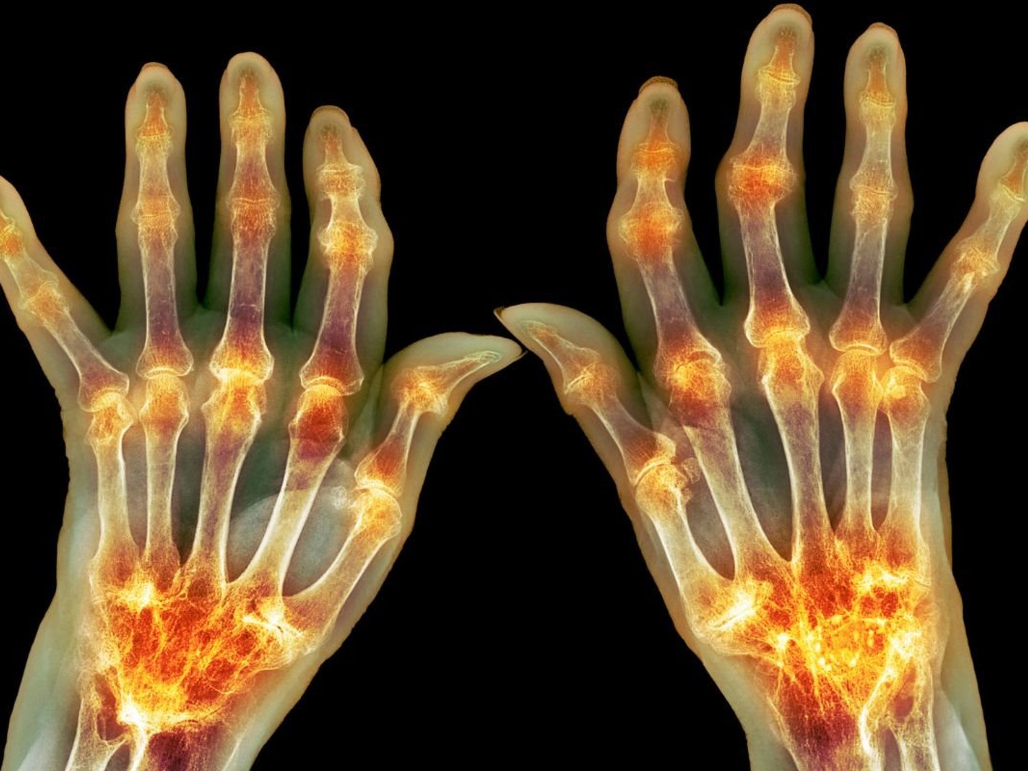ARTHRITC HANDS