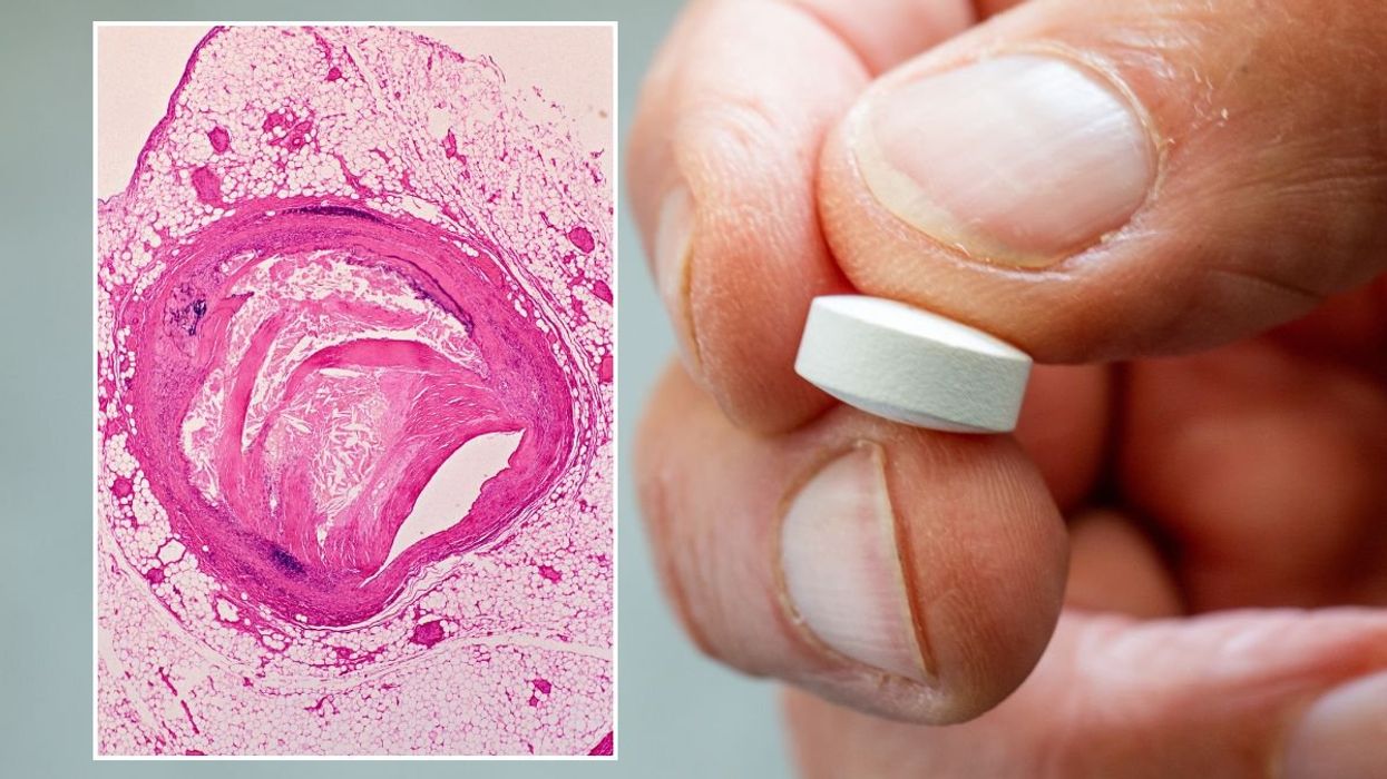 ATHEROSCLEROSIS UNDER A MISCROSCOPE / WHITE PILL