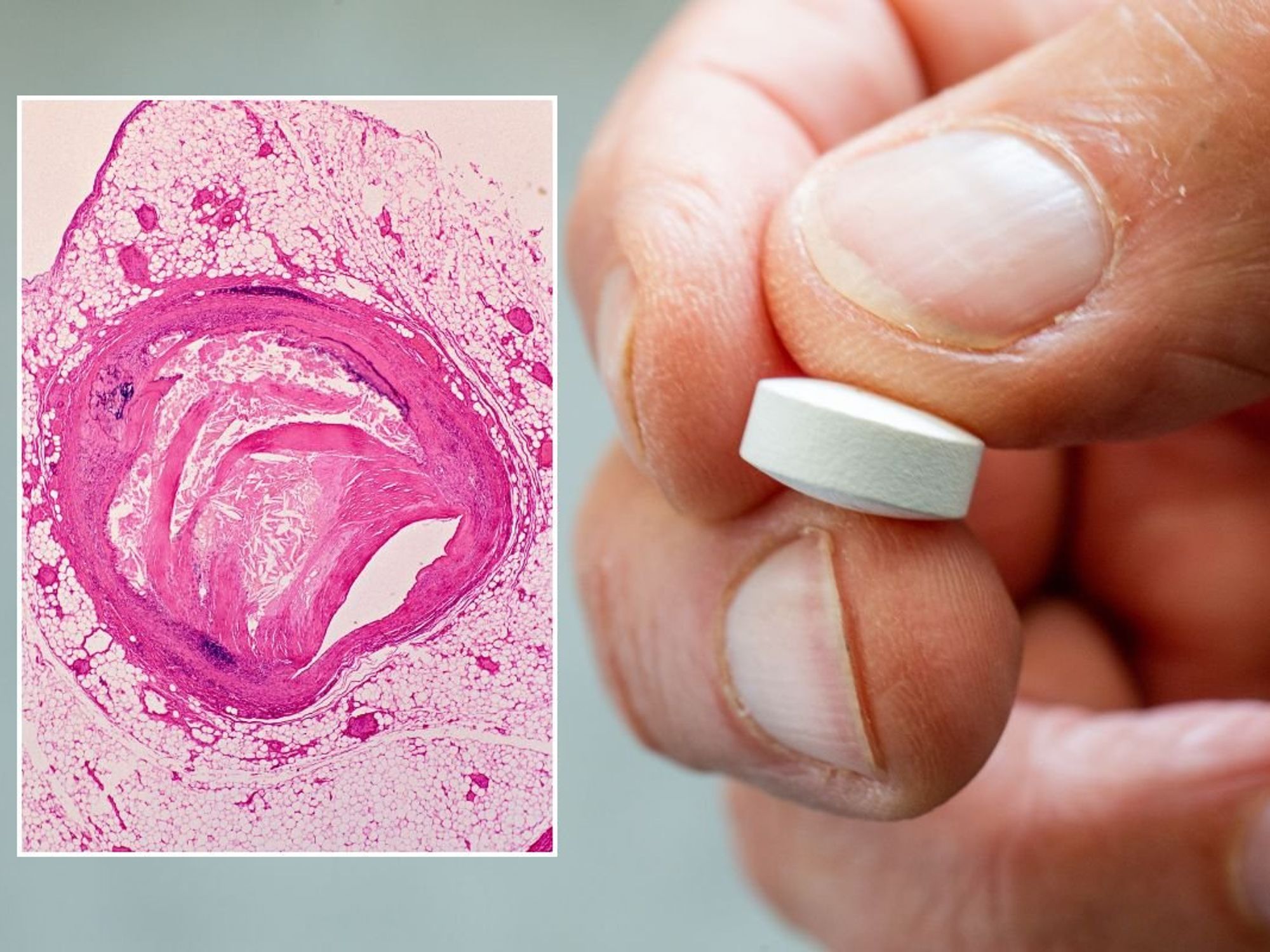 ATHEROSCLEROSIS UNDER A MISCROSCOPE / WHITE PILL