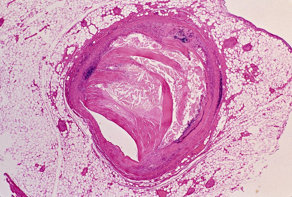 ATHEROSCLEROSIS UNDER A MISCROSCOPE