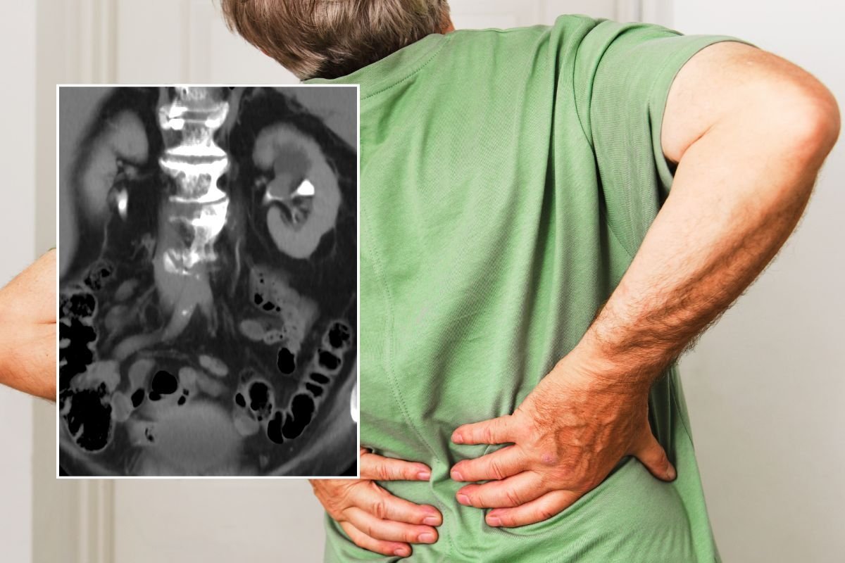 Back pain and kidney cancer scan