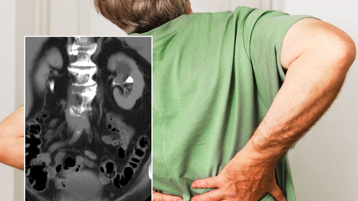 Back pain and kidney cancer scan