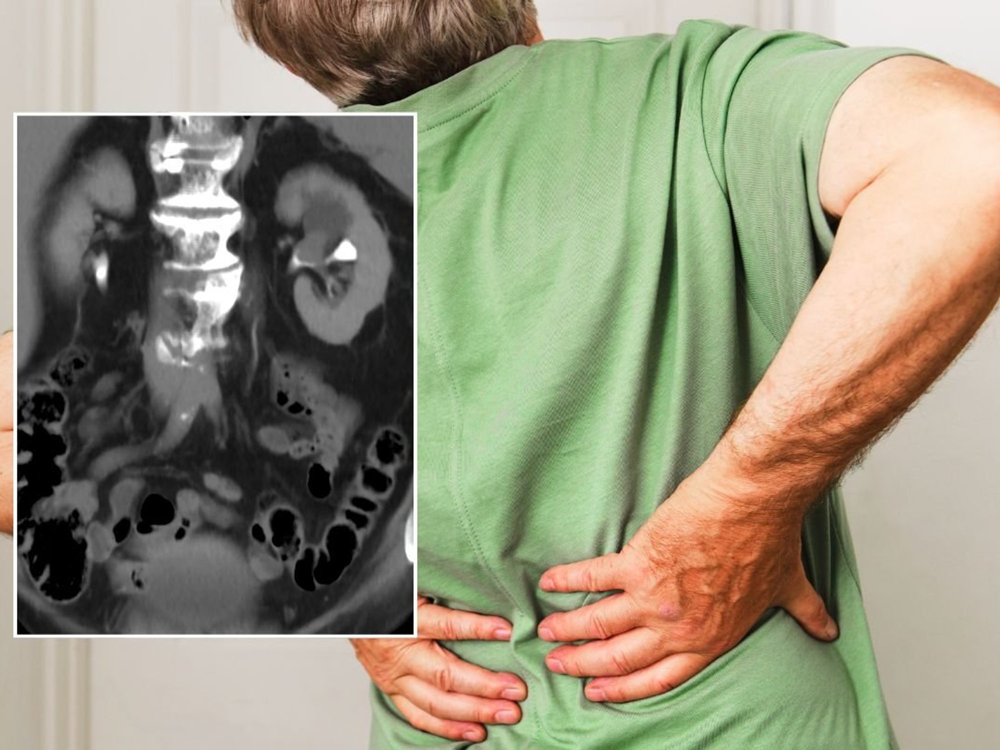 Back pain and kidney cancer scan