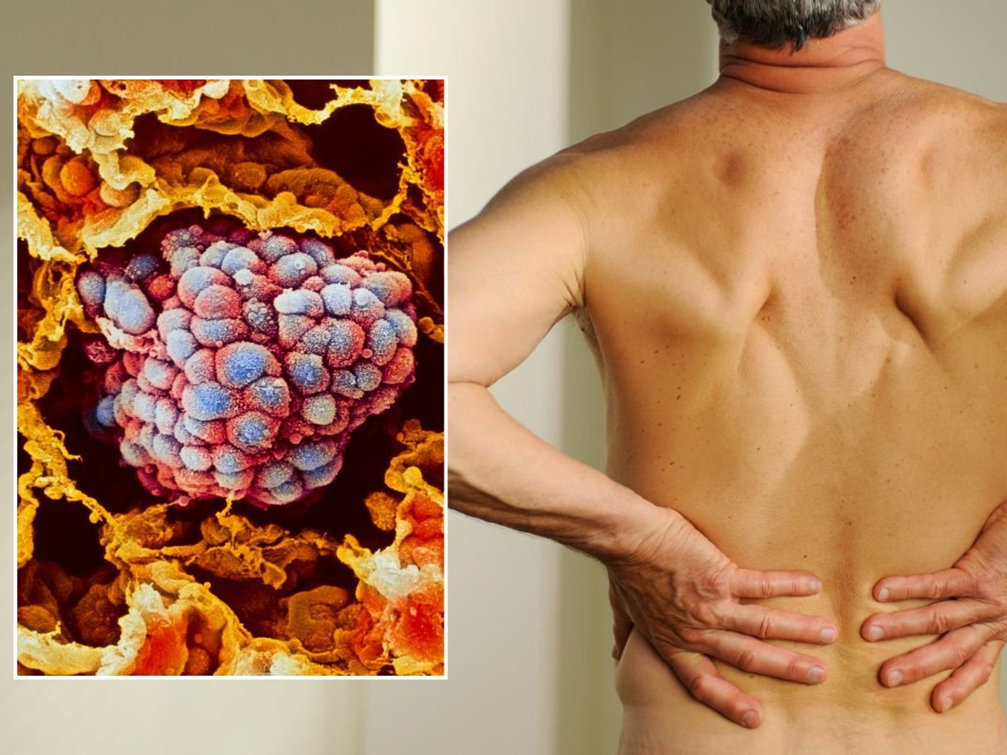 Back pain and lung cancer