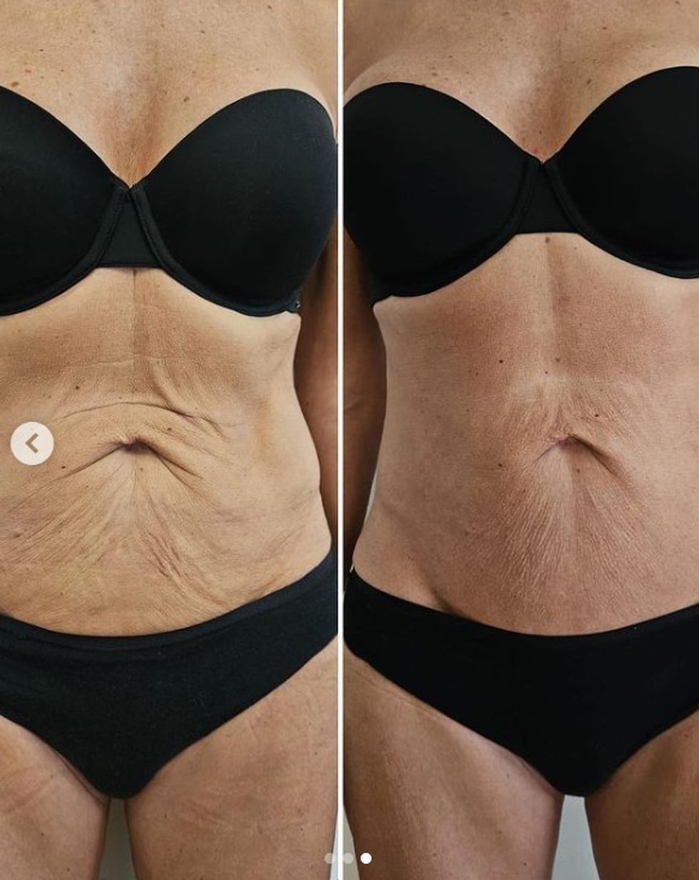 Before after skin tightening treatment