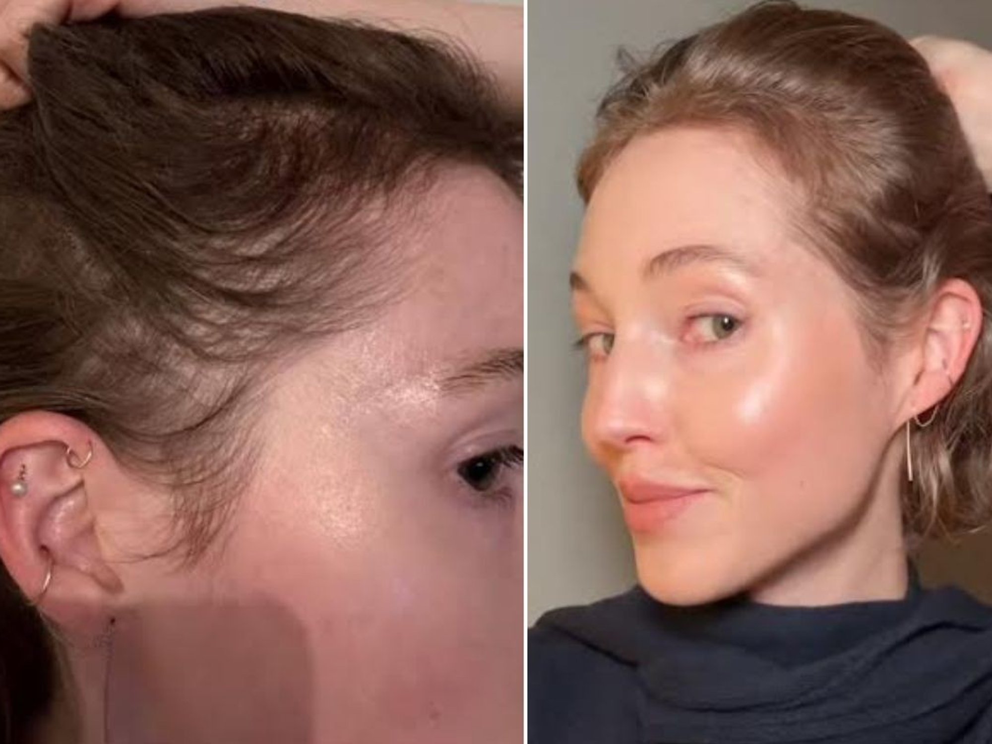 BEFORE AND AFTER PICS OF HAIRLINE