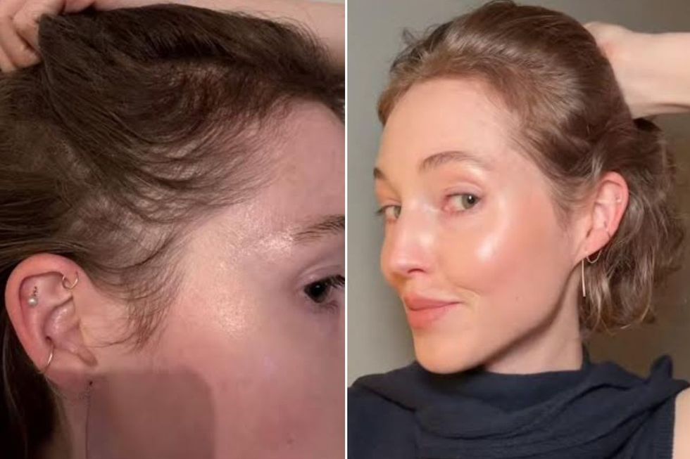 BEFORE AND AFTER PICS OF HAIRLINE