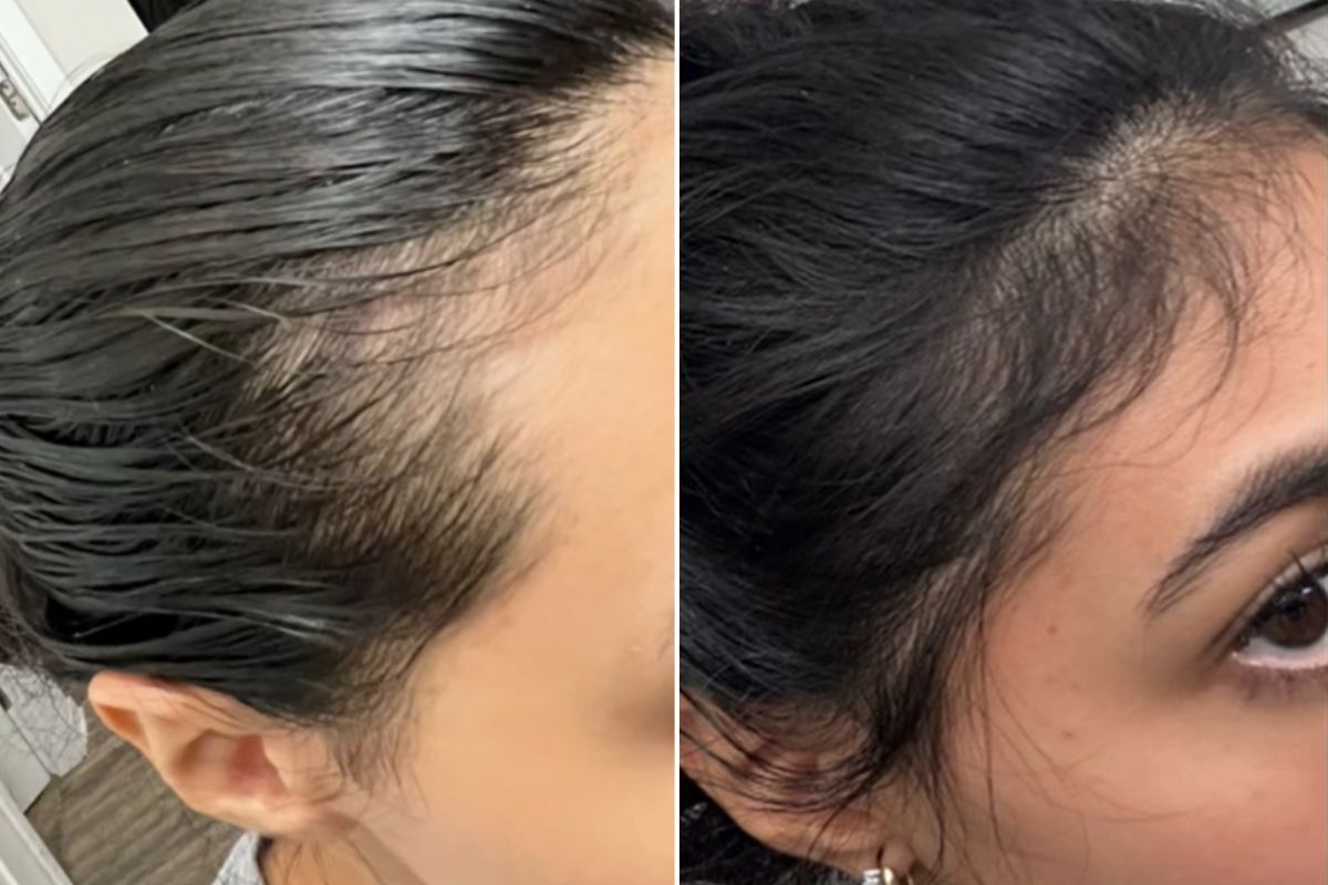 BEFORE AND AFTER PICTURE HAIRLINE