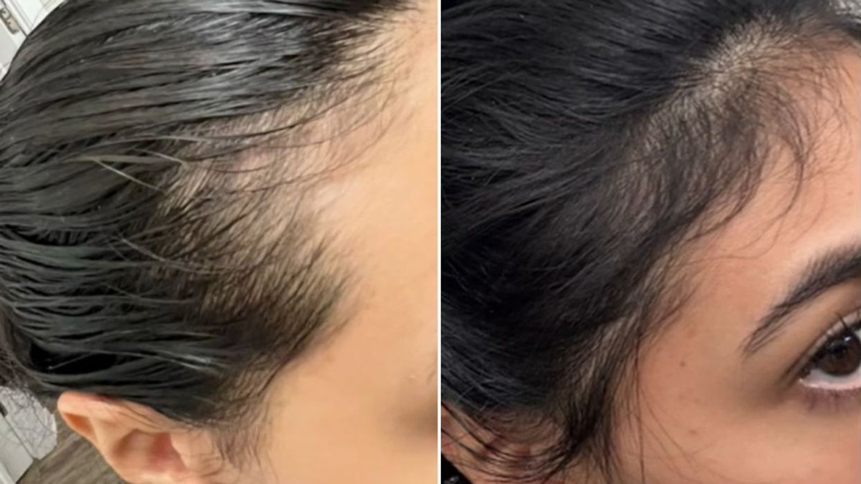 BEFORE AND AFTER PICTURE HAIRLINE