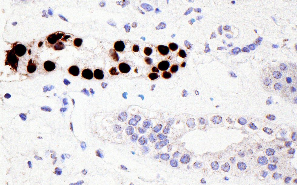 BLADDER cancer cells under microscope