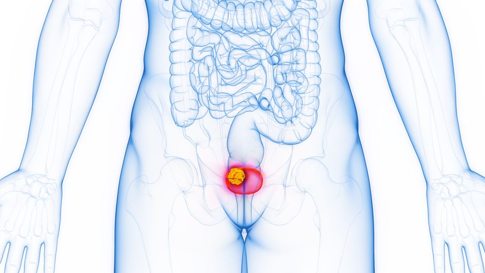 BLADDER CANCER ILLUSTRATION