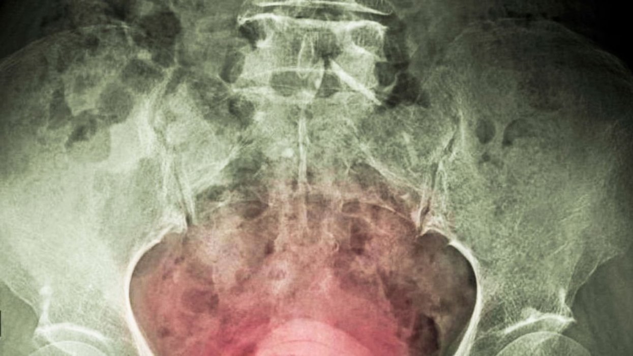 BLADDER CANCER ILLUSTRATION