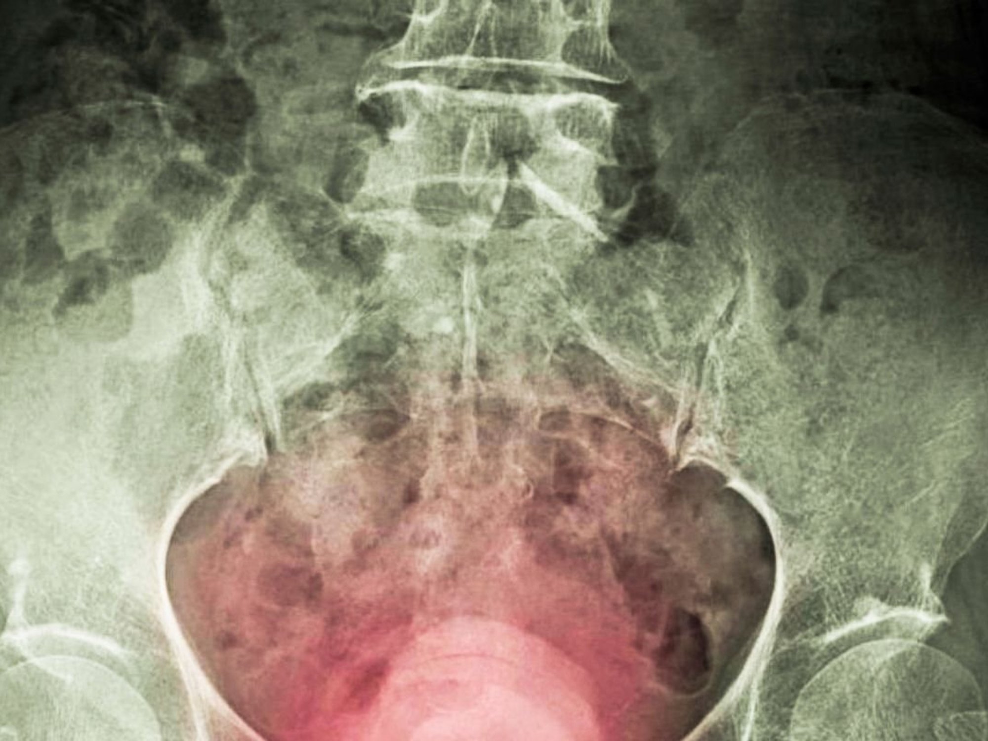 BLADDER CANCER ILLUSTRATION