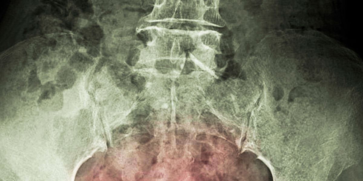 Groundbreaking treatment could help bladder cancer patients avoid 'life-changing' surgery