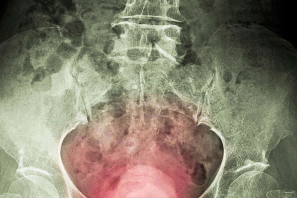 BLADDER CANCER ILLUSTRATION