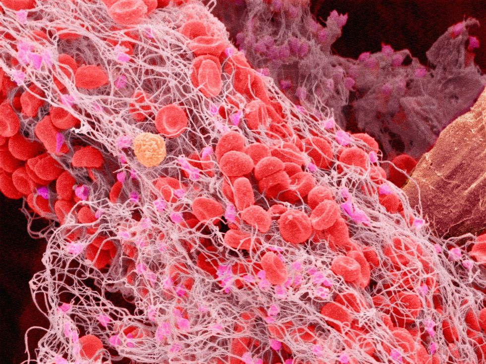 BLOOD CLOT COMPOSITE