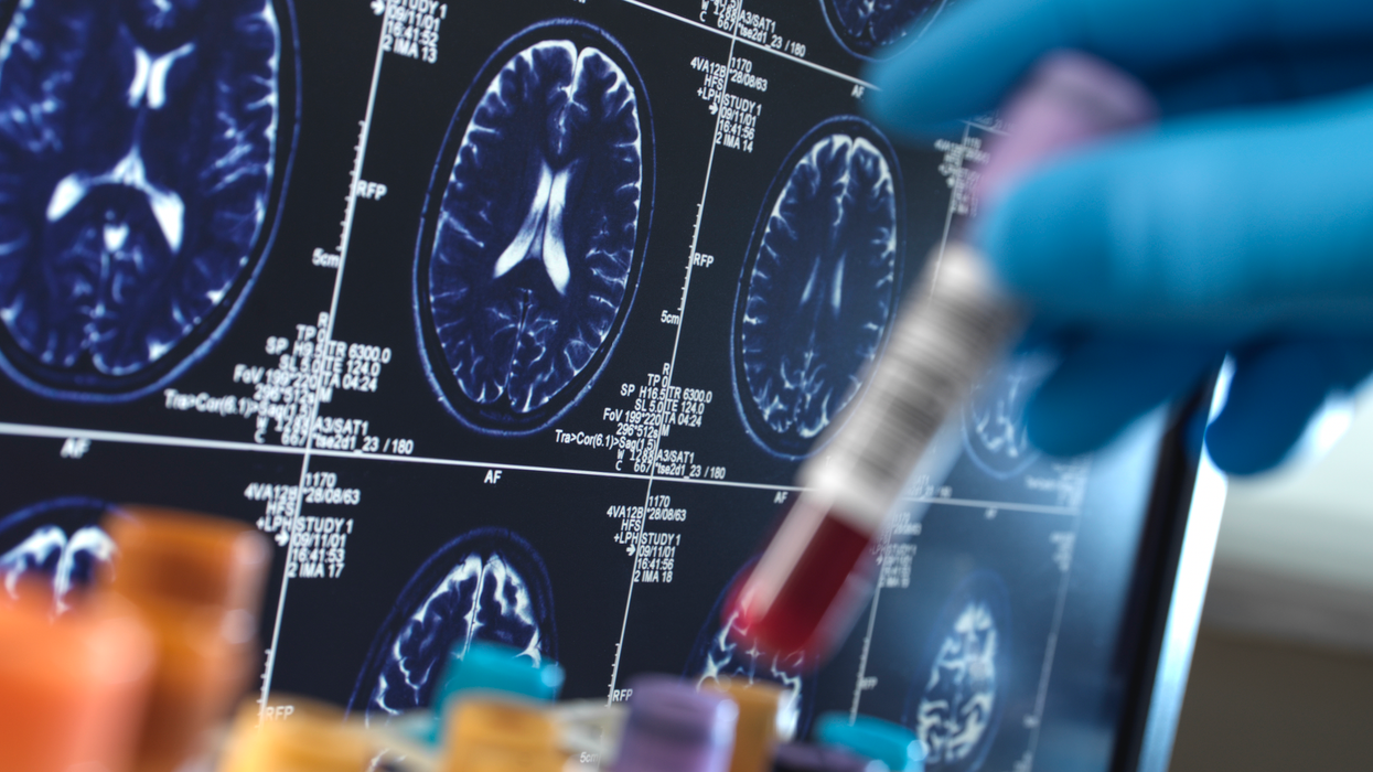 Blood test in front of a brain scan