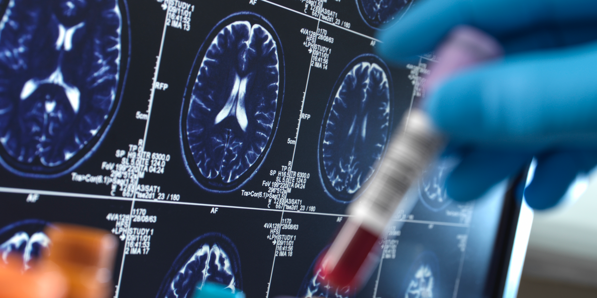 NextImg:Thousands of Britons to be offered quick and easy blood test for Alzheimer's in UK trial - are you eligible?